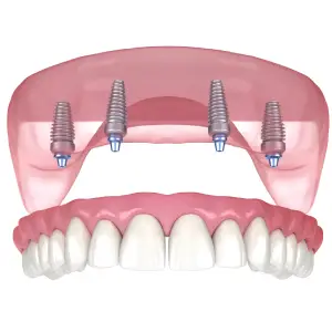 Snap-on Dentures in Jacksonville, FL