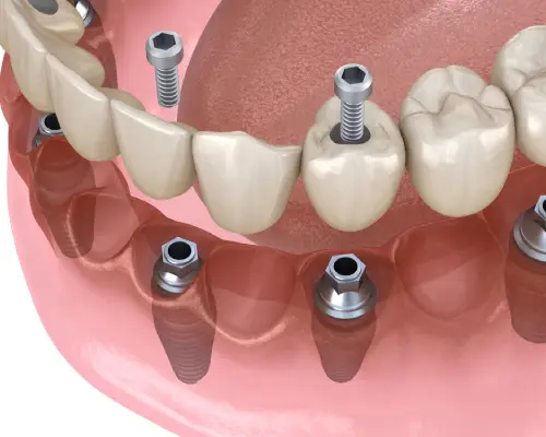 All-on-4 vs. Traditional Dental Implants