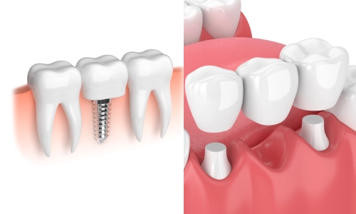 Dental Bridge Vs Implants