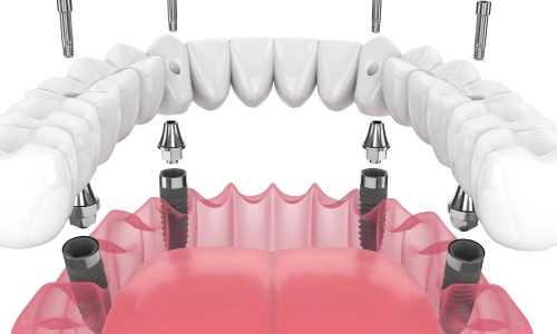 How Long Do All-on-4 Dental Implants Last?