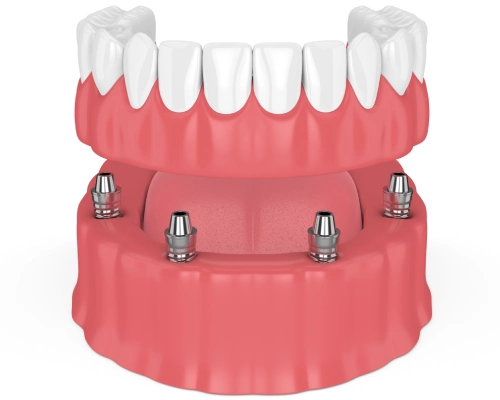 Can Dentures Be Stabilized with Dental Implants?
