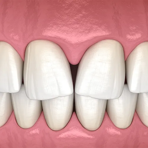 How to Fix Gaps Between Teeth
