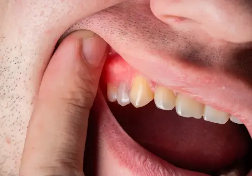 How Long a Tooth Abscess Takes to Heal?