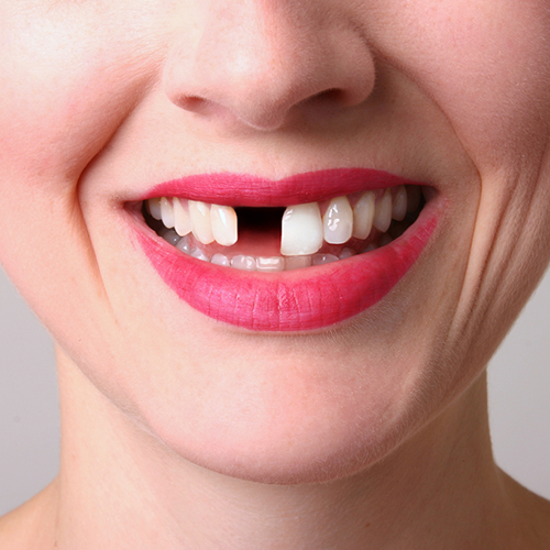 Tighten Loose Tooth at Home Safely