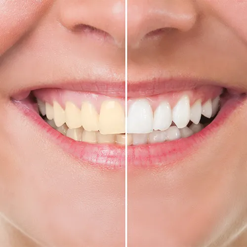 Tooth Discoloration: Causes and Treatment Options