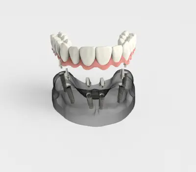 All-on-4 vs. All-on-6 Dental Implants