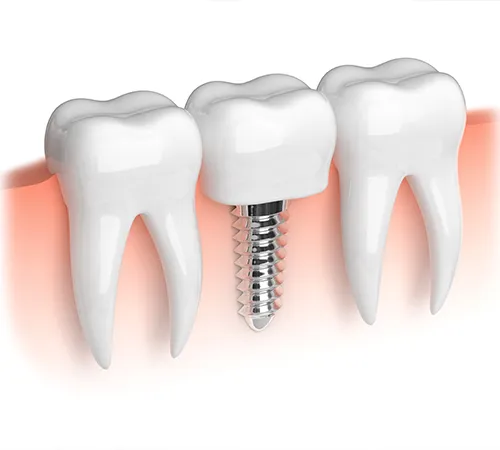 Do Dental Implants Cause Bone Loss