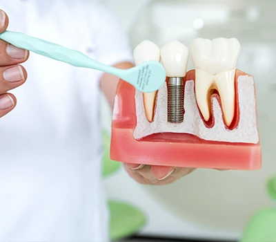 Success Rate of Dental Implants