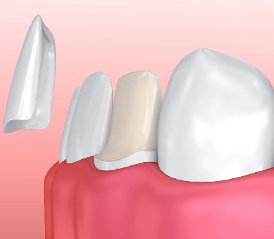 Porcelain vs. Composite Veneers
