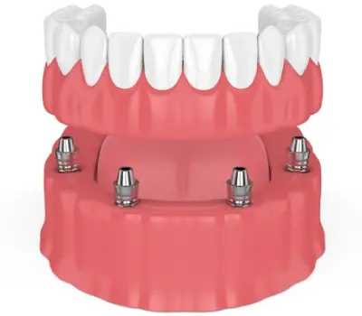 Best Type of Denture Stabilization