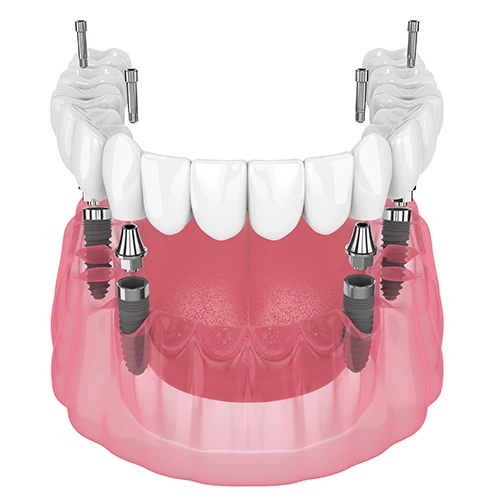 All on 4 Dental Implant Problems