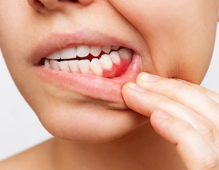 Gum swelling being a reason for tooth extraction in Jacksonville, FL