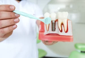 Factors Affecting “Do Implants Last Forever