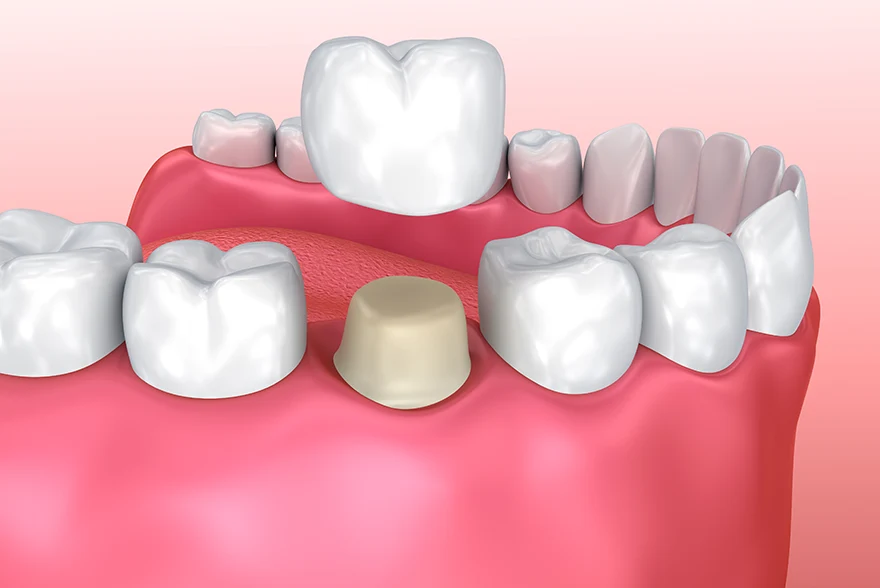 dental crown Jacksonville
