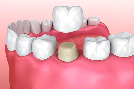 Fillings, Crowns, & Bridges