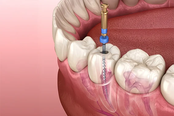 root canal jacksonville