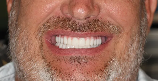 Smile-After-1