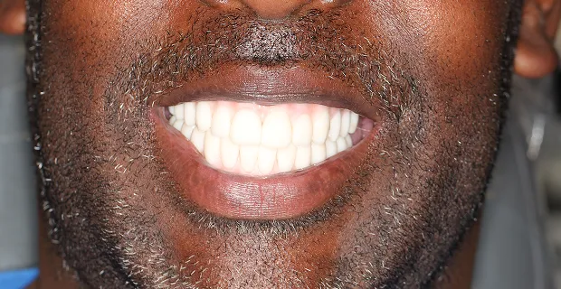 Smile-After-10
