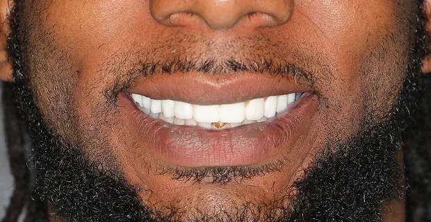 Smile-After-11