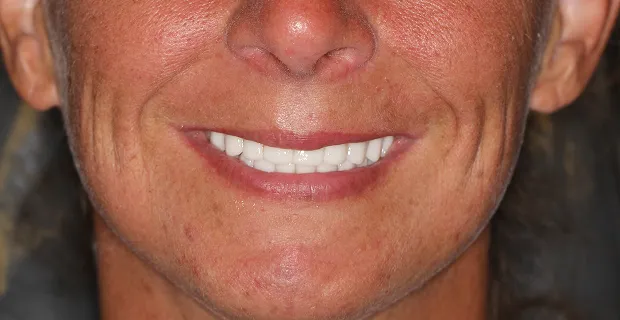 Smile-After-12