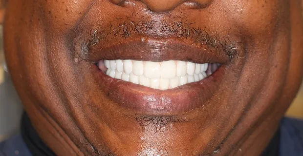 Smile-After-13