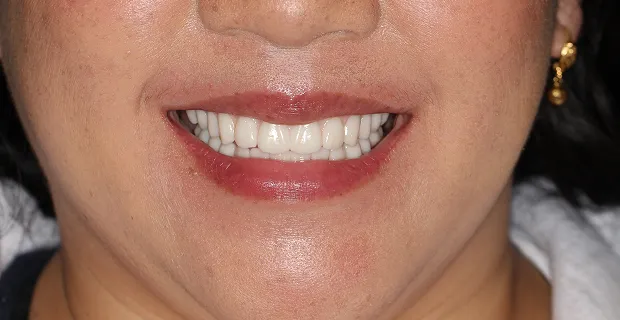 Smile-After-14