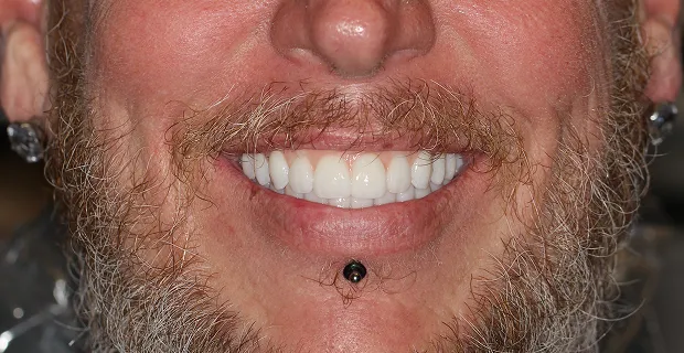 Smile-After-15