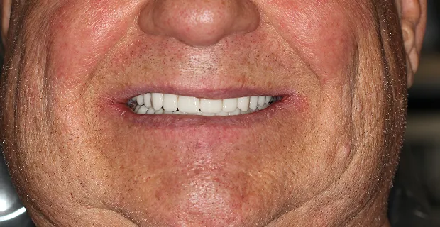 Smile-After-16
