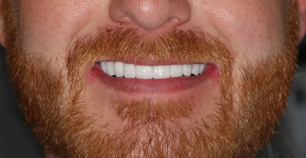 Smile-After-18