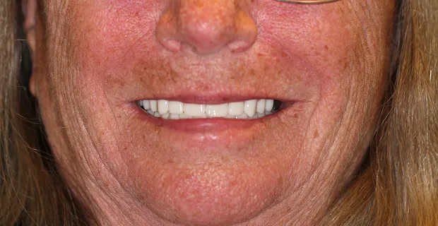 Smile-After-19