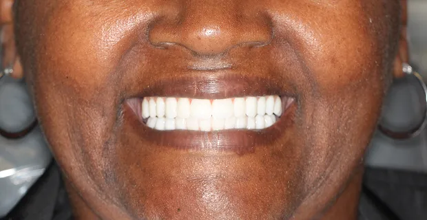 Smile-After-2