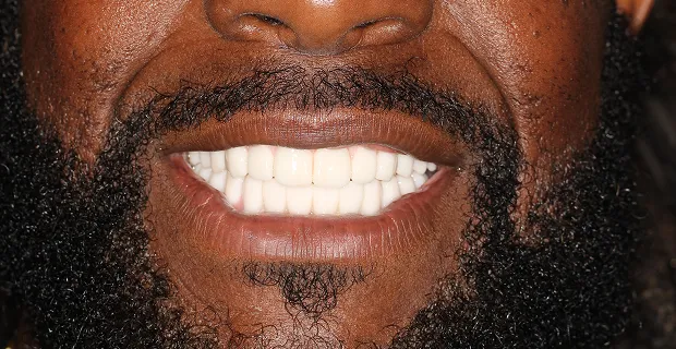 Smile-After-20