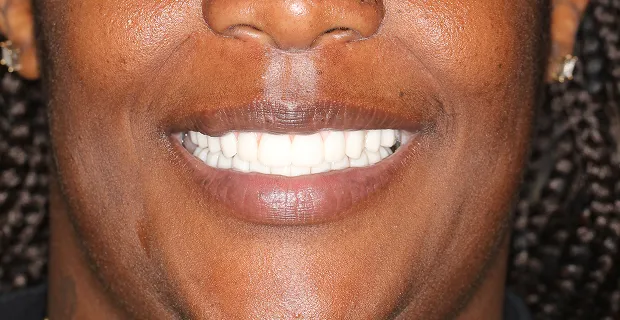 Smile-After-3