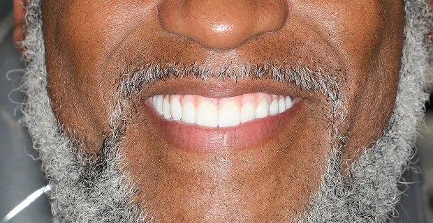 Smile-After-4