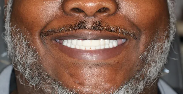 Smile-After-5