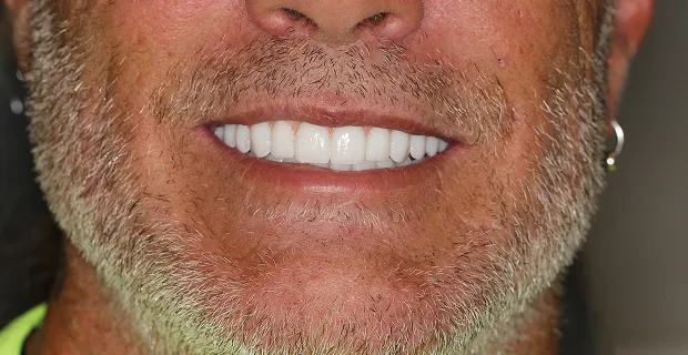 Smile-After-8