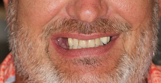 Smile-Before-1