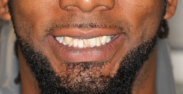 Smile-Before-11