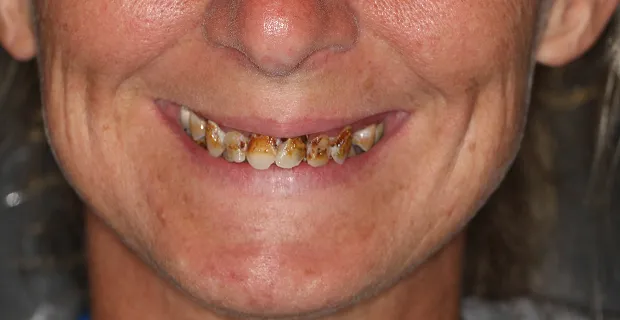 Smile-Before-12