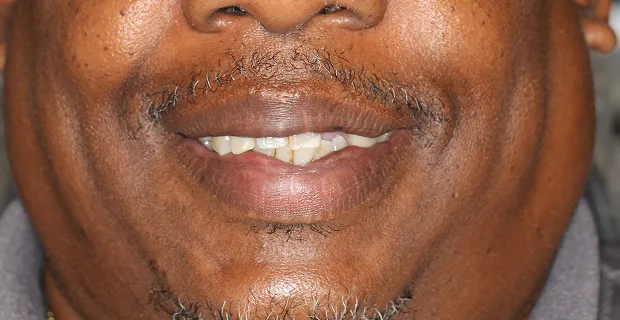 Smile-Before-13