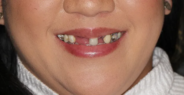 Smile-Before-14