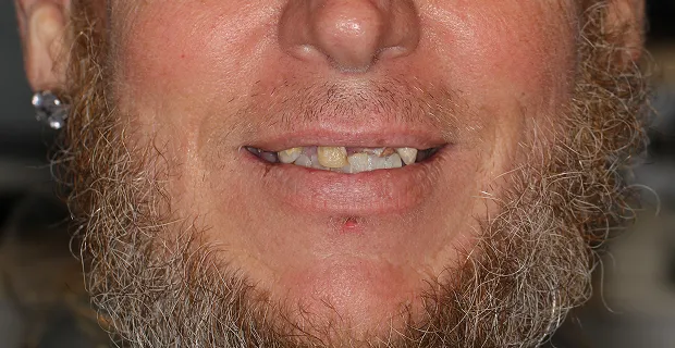 Smile-Before-15