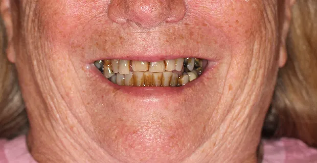 Smile-Before-19