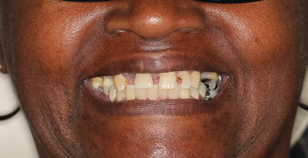 Smile-Before-2