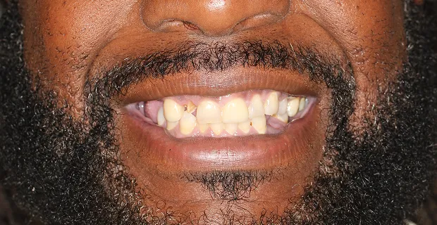 Smile-Before-20
