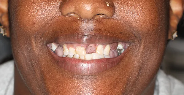 Smile-Before-3
