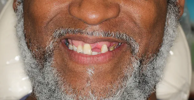 Smile-Before-4