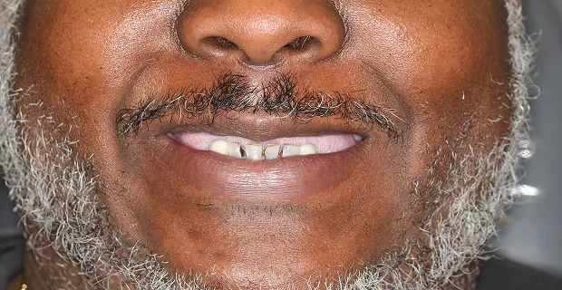 Smile-Before-5