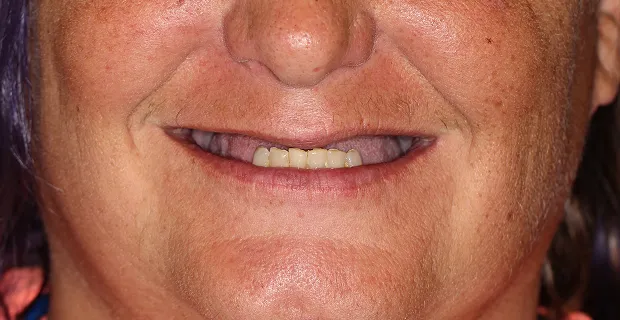 Smile-Before-9