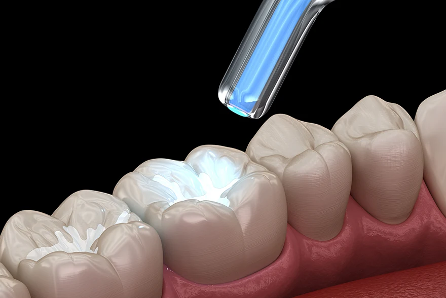 Dental Fillings Jacksonville